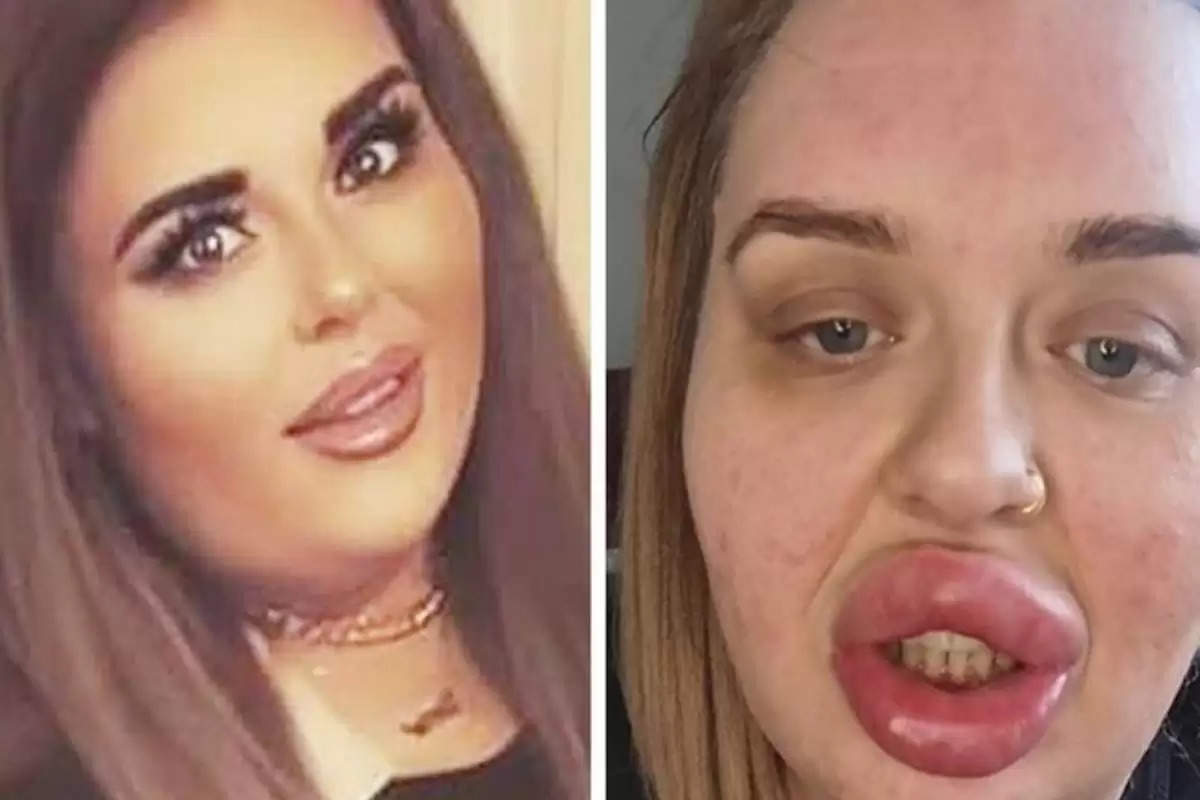 Six-times-larger-lip-Disaster-for-the-woman