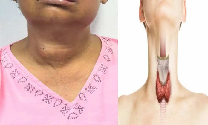 Thyroid