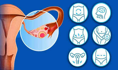 Ovary cancer